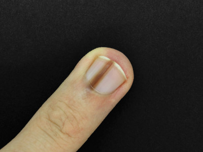 Muncul Garis Hitam di Kuku, Apakah Berbahaya?
